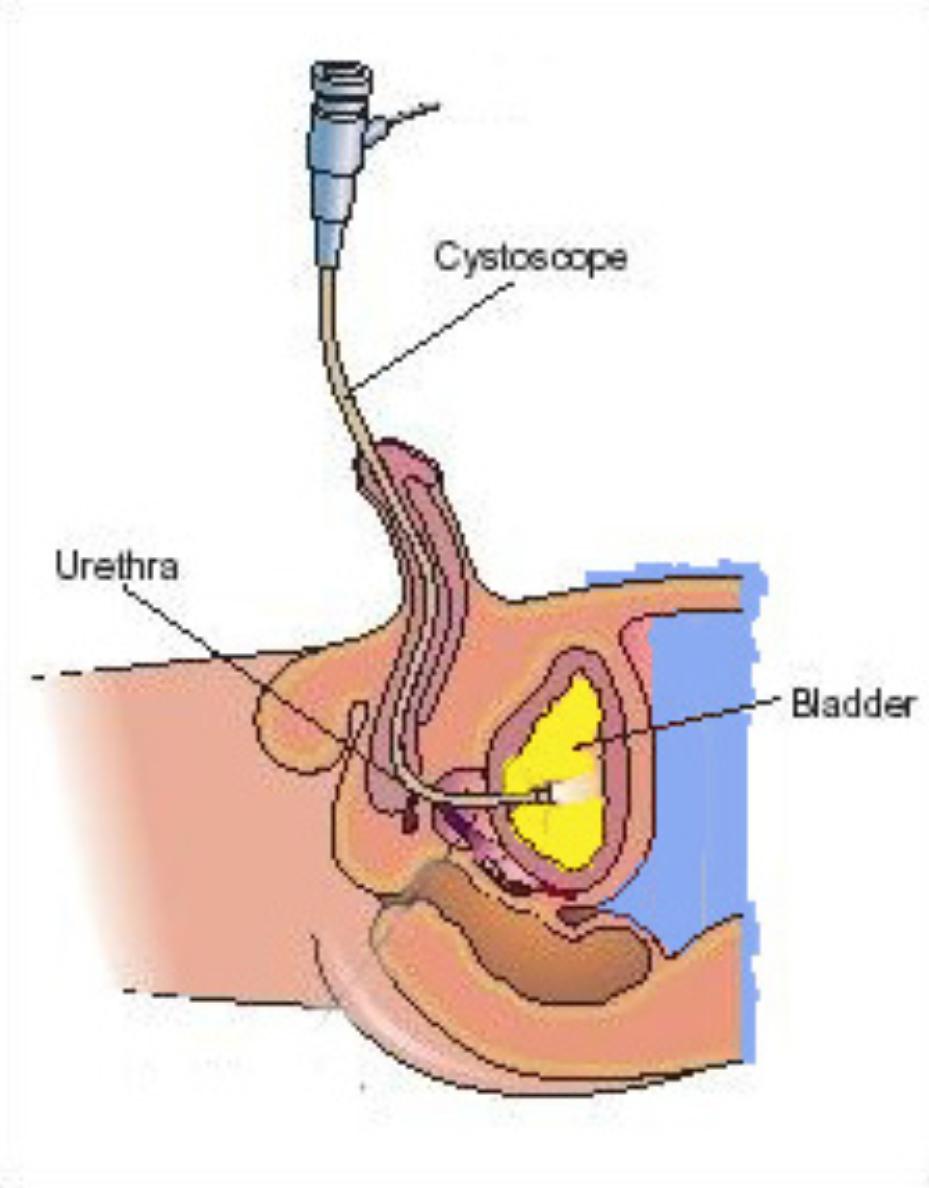 WHAT IS A FLEXIBLE CYSTOSCOPY A flexible cystoscopy is a test to examine the uretha (waterpipe) and bladder using a thin, lighted and flexible tubelike telescope called a cystoscope.