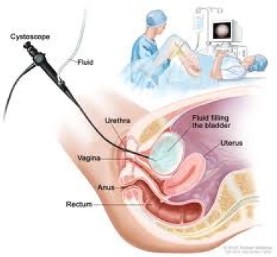 You will need to lie on your back on a couch for the test to be performed. Flexible cystoscopy is routinely done as an outpatient or day case under local anaesthesia.