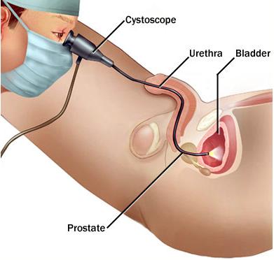 bladder. This discomfort should pass once the cystocope is in the bladder. You will be asked to relax and even to try to pass water as the telescope is passed into the bladder.