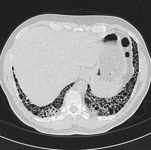 FIGURE 1 High-resolution computed tomography scan showing typical appearance of usual interstitial pneumonia. subpleural and parallel to the chest wall.