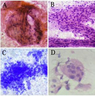 A-158 Cytology of Sensory Cutaneous Nerve in Leprosy power fields, and many (++) if many bacilli per high-power field were seen. Negative finding was denoted as absent ( ).