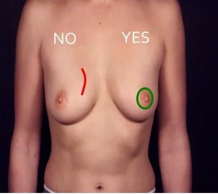Aesthetic of Breast Reconstruction Careful scar