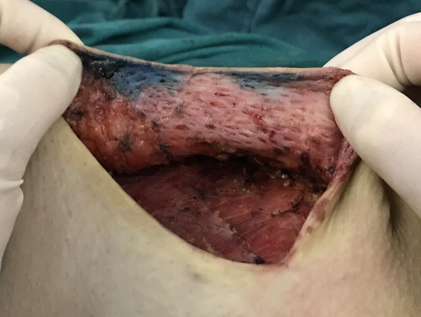Skin flap thickness The thicker the skin flap, the better the mammary aesthetics is after reconstructure. Be sure to stick to the baseline of the oncology safety.