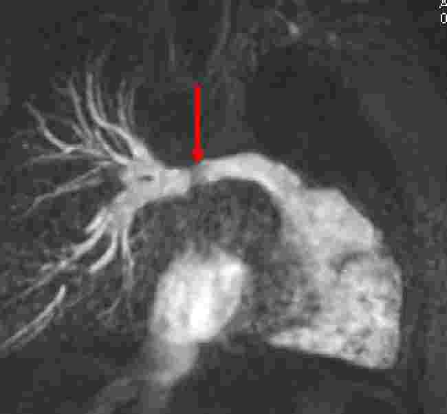 MR angiography S t ent
