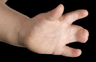 Syndactyly means joined digits and may involve webbing of the skin, or include fusion of the underlying bones. This may be along part or the whole length of the finger.