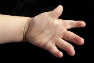 Syndactyly happens when two or more fingers fail to completely separate during development. Sometimes syndactyly occurs by chance or it may be inherited.