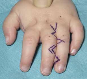 Markings showing the zig zag incisions How is syndactyly treated? It is treated surgically under a general anaesthetic.