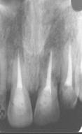Permanent restoration almost closed, prophylactic root canal treatment should be carried out on the day of splint removal to prevent the onset of inflammatory