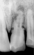 Andreasen has shown that resorption defects occur on the root surface adjacent to the areas of damage to the periodontal ligament during avulsion or extended