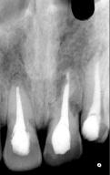 Dry extra oral time after avulsion in the present case was more than 1 hour and during this period tooth was not stored in any suitable medium instead was kept