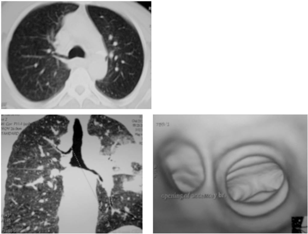 952 The Role of Multislice CT in Imaging of Different Tracheal Lesions Case (): Axial CT chest (lung window)