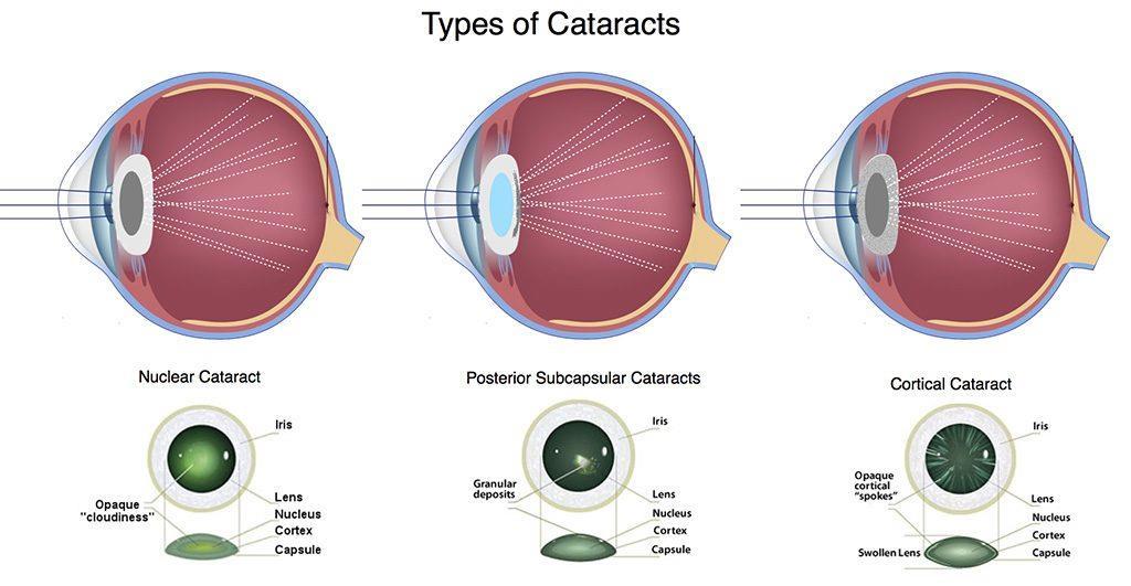 2. Cortical Cataracts "Cortical" refers to white opacities, or cloudy areas, that develop in the lens cortex, which is the peripheral (outside) edge of the lens.