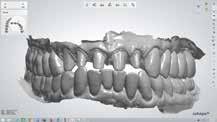 2 Provisional restorations serve as the basic template for the definitive restorations and ensure their predictability by confirming the design of the occlusion,