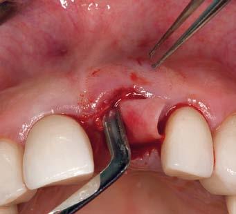 reliable solution. Situation after extraction of a tooth with root caries.
