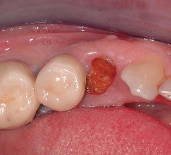 Daniel Buser, Berne, Switzerland: We use Geistlich Bio-Oss Collagen routinely for triple tooth gaps in the