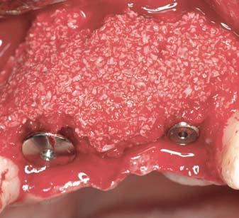 Following delicate extraction, the alveolus is filled with Geistlich Bio-Oss Collagen.