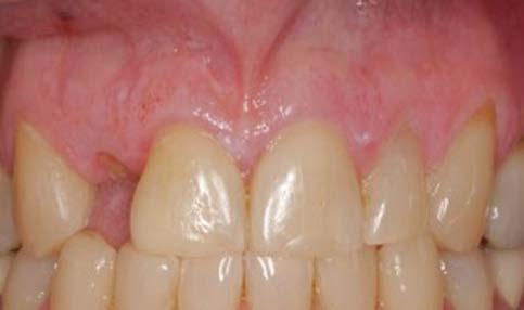 Insufficient Soft-Tissue Thickness in a Single Tooth Gap in the