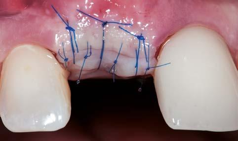 left central incisor with labial soft-tissue
