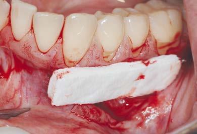 The matrix was developed using the free gingival graft as a model and is uniquely processed to encourage immediate blood clot stabilization, making it the ideal solution for gaining keratinized