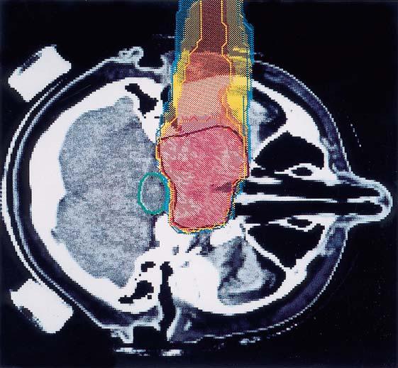 120 7. Radioisotopes in Medicine Fig. 7.3. Distribution of biological effective dose (isodose contours from carbon ion deposition) is shown superimposed on the image of the brain.