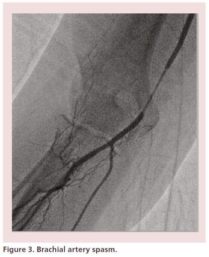 Percutaneous Radial Access for Peripheral Transluminal Angioplasty 2015 Coscas et al.