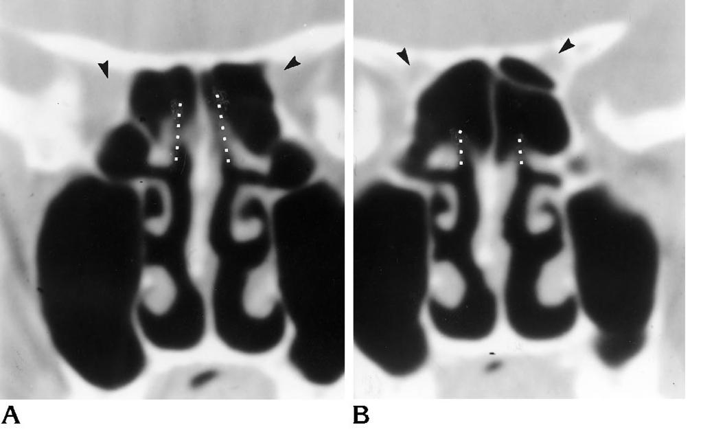 Coronal CT scans from anterior (A) to posterior (B) reveal the sphenoethmoidal recesses (dotted lines).
