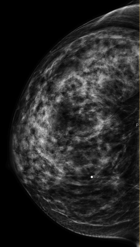 Mammography CC MLO Extremely dense breast tissue.