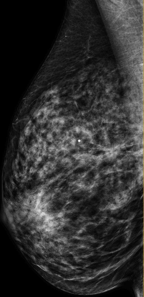 quadrant of the right breast with overlying BB marker