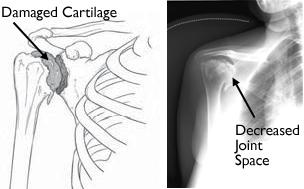 There are two joints in the shoulder, and both may be affected by arthritis. One joint is located where the clavicle meets the tip of the shoulder blade (acromion).