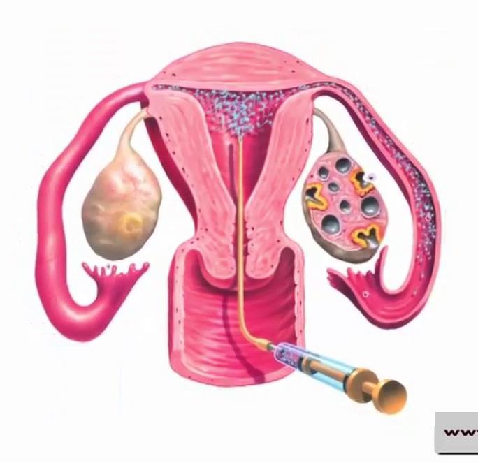 Intra-uterine insemination Widely accepted treatment Increased sperm density in upper reproductive tract