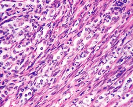Lobular breast carcinoma metastatic to