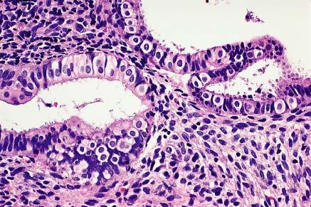 Tubal metaplasia of endometrial mucosa.