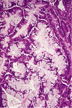 Clear cell metaplasia of endometrium.