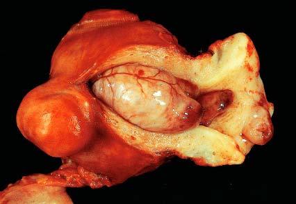 Huge endometrial polyp filling the endometrial cavity.