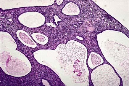 Low-power appearance of endometrial polyp showing cystically