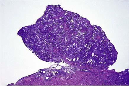 A, Whole-mount appearance of atypical polypoid adenomyoma.