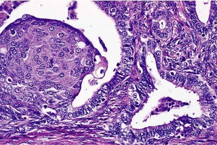 B, High-power appearance of atypical polypoid adenomyoma.