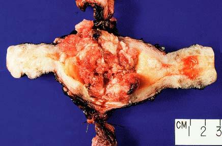 Gross appearance of papillary serous carcinoma of