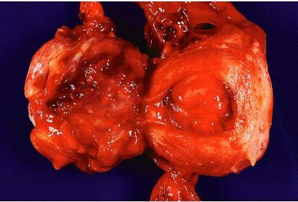 Gross appearance of small cell neuroendocrine carcinoma of