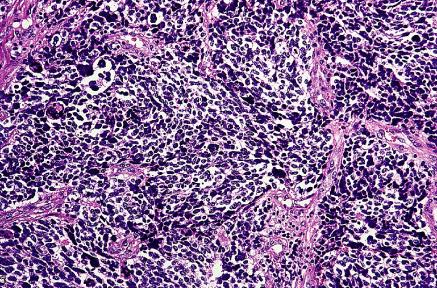 Small cell neuroendocrine carcinoma of