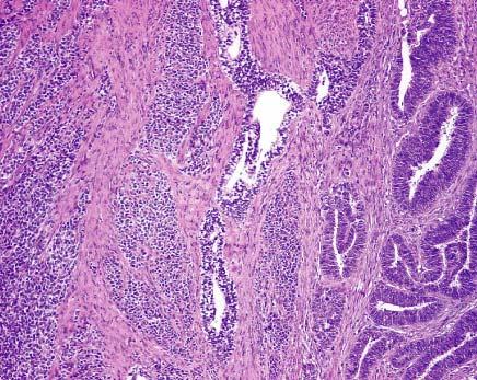 Small cell neuroendocrine carcinoma of endometrium admixed