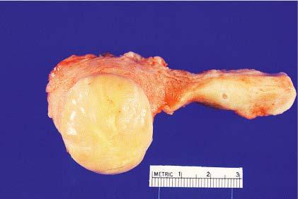 Endometrial stromal nodule.