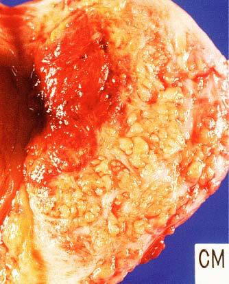 Low-grade endometrial stromal sarcoma showing diffuse permeation of