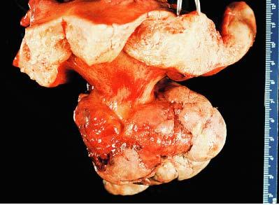 Low-grade endometrial stromal sarcoma presenting as a huge polypoid mass