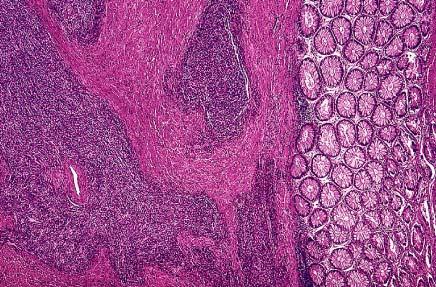 Endometrial stromal sarcoma