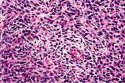 A, Low-power appearance of endometrial stromal sarcoma metastatic to lung.