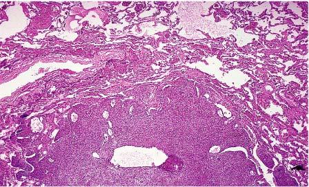 B, High-power appearance of endometrial stromal sarcoma metastatic to lung.