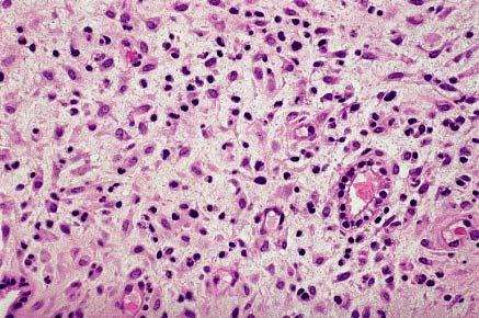 Typical appearance of endometrium after long-term administration of contraceptive pills.
