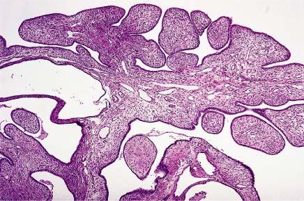 Papillary adenofibroma of uterus.