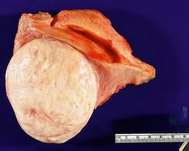 Large uterine leiomyoma with